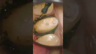 Vertical preparation gingivectomy before impression