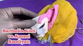🟡 Bartholin Kisti Ameliyatı Nedir? | Apse Belirtileri Nelerdir? | Marsupializasyon Yöntemi