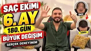 Değişim - Saç Ekimi - 6. AY (180 Gün)