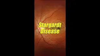 Stargardt disease