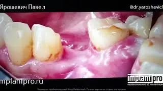Ярошевич Павел - Работа с мягкими тканями