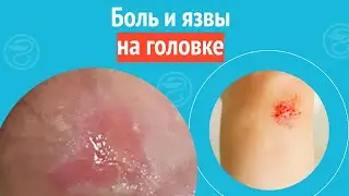 😲 Боль и язвы на головке. Клинический случай №1213