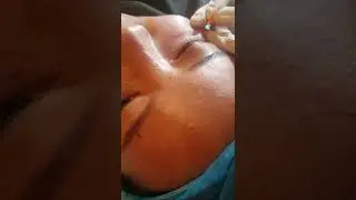 PDO Threads for Under Eye & Tear Trough Eye Rejuvenation