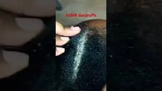 ASMR dandruffs scratch 
