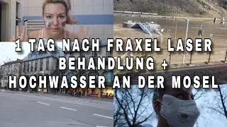 1 Tag nach Fraxel Laser Behandlung + Reise nach Bayern mit Hochwasser