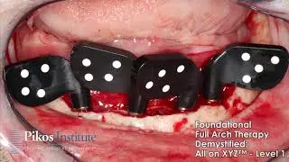 Full Arch All on 4, Mandibular All on X Case. Full Arch All on Four Course