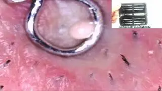 Pimple Popper Tools!  Acne and Dermatology
