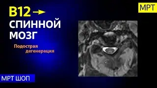 Подострая комбинированная дегенерация спинного мозга при дефиците витамина B12