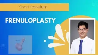 Understanding Frenuloplasty: Procedure, Benefits, and Recovery
