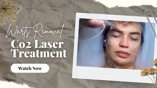 Warts Removal via Carbon Laser Treatment