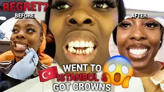 VLOG: I GOT CROWNS!! COST... MY TEETH ARE GONE (BEFORE&AFTER)... WORTH IT?? FULL INFORMATION!!