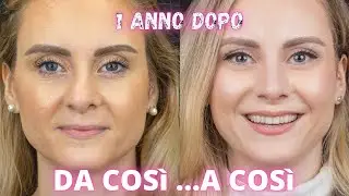 RINOPLASTICA 1 ANNO DOPO...NON E' ANDATA COME SPERAVO 😥