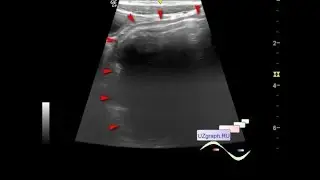 Pediatric abdominal ultrasound - Megacolon