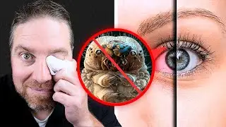 Best Eyelid Wipes To Get Rid Of Eyelid Mites!