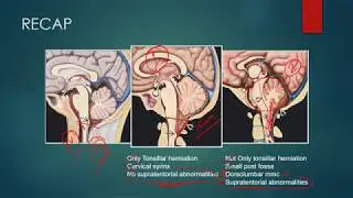 CHIARI MALFORMATIONS RADIOLOGY CT MRI