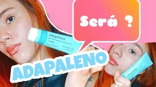 Como acabar com as espinhas (adapaleno)