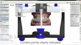 Features of the Ortho Analyzer - Treatment Planer from 3Shape