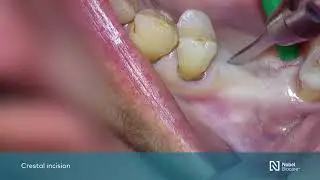 Maxillary sinus floor elevation with simultaneous implant placement with GBR