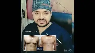 3 THINGS ABOUT GYNECOMASTIA SURGERY!