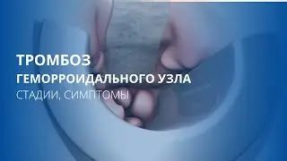 Тромбоз геморроидального узла. Стадии, симптомы.