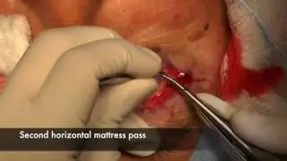 External Ptosis Repair