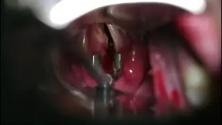 Зернистоклеточная опухоль гортани / Laryngeal granular cell tumor