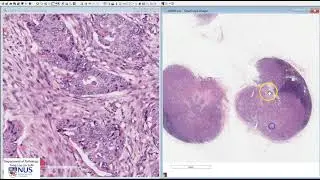 Breast: Invasive carcinoma NST with lymph node metastases Microscopy (Talking slide)