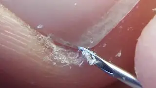 Cleaning fingernail with hypodermic needle.