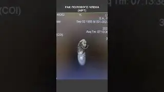 Рак полового члена (МРТ)