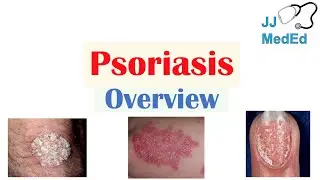 Overview of Psoriasis | What Causes It? What Makes It Worse? | Subtypes and Treatment
