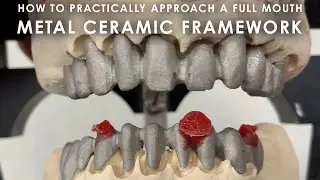 How to practically approach a Full Mouth Metal Ceramic Framework
