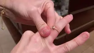Removing discoloration from gold ring