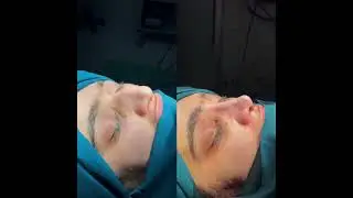 Нозим Шокирович. Ринопластика носа. Душанбе Таджикистан.