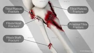 A Motorcyclist Is Struck By A Vehicle Resulting In A Partial Leg Amputation