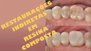 Restaurações indiretas de resina composta