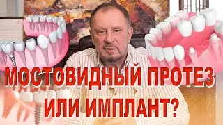 Мост или имплант?