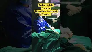 Chauffeur fracture(radial styloid fracture) fixation with k-wire #radius #fracture #wristinjuries