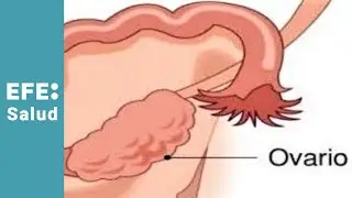 ¿El fallo ovárico prematuro genera infarto de miocardio?