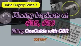 Placing Implants at #35, #36 Using OneGuide and GBR