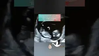 УЗИ с подтвержденной беременностью - ЭКО Виталис