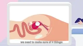 HIFU- High intensity focused ultrasound for fibroid