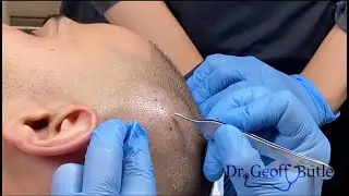 Pilar Cyst Removal from Scalp