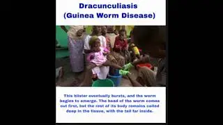 Guinea Worm Disease (Dracunculiasis) - Dracunculus