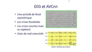 Quoi de neuf dans la prise en charge de l’AVC ischémique néonatal ?