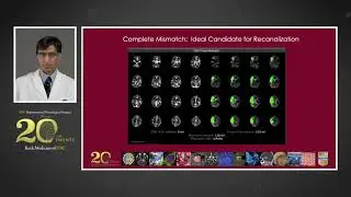 Neurosurgical Management of Acute Ischemic Stroke