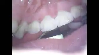 Inside my mouth backwards - VORE ENDOSCOPE