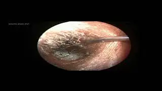 Big Black Ear Wax Removal