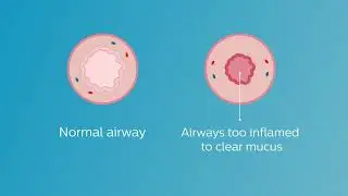 RespirTech Bronchiectasis Animation Video