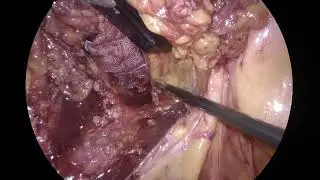 Protectomy and IPAA for rectal dysplasia after ileorectal anastomosis in Crohns disease