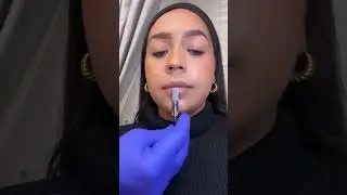 Non-surgical chin contouring